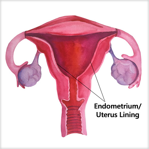endometrial hyperplasia
